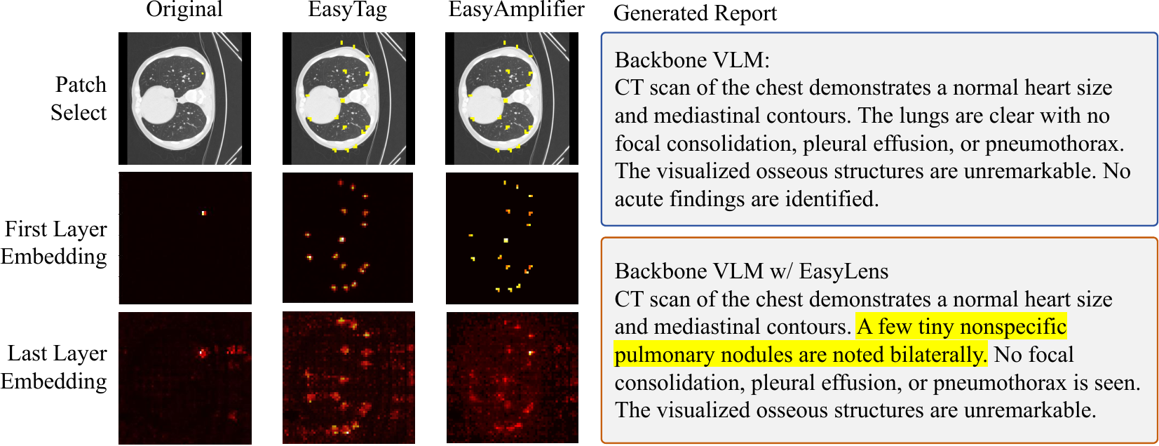 EasyLens case study on a small pulmonary nodule