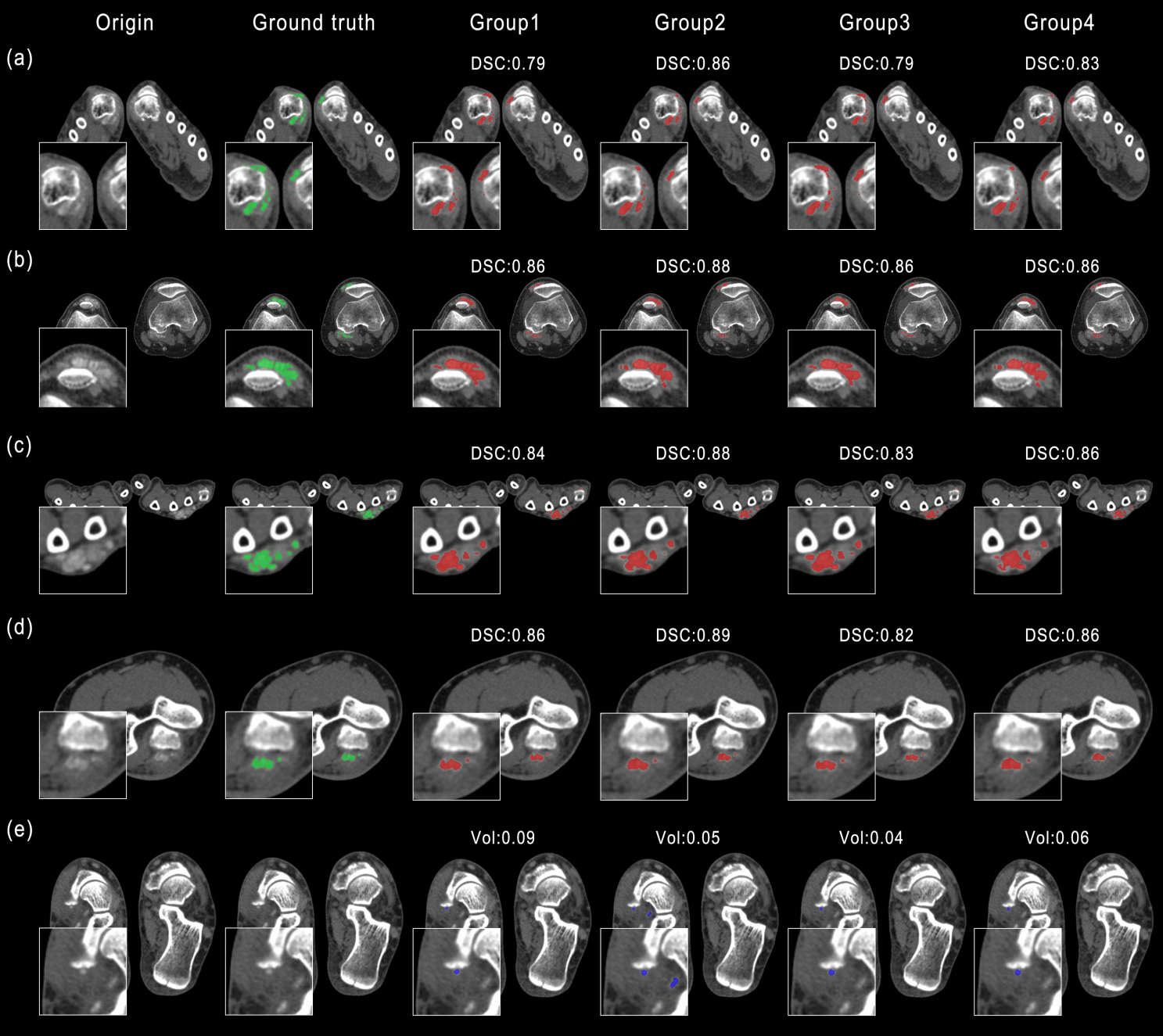 Gout detection results